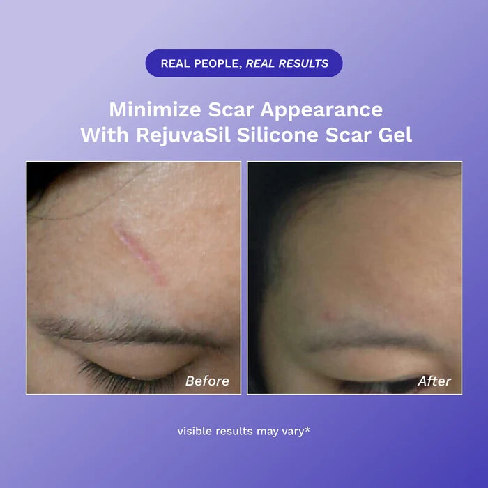 RejûvaSil Silicone Scar Gel 1 oz (8000)